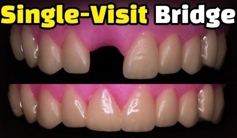 Single-Visit Bridge