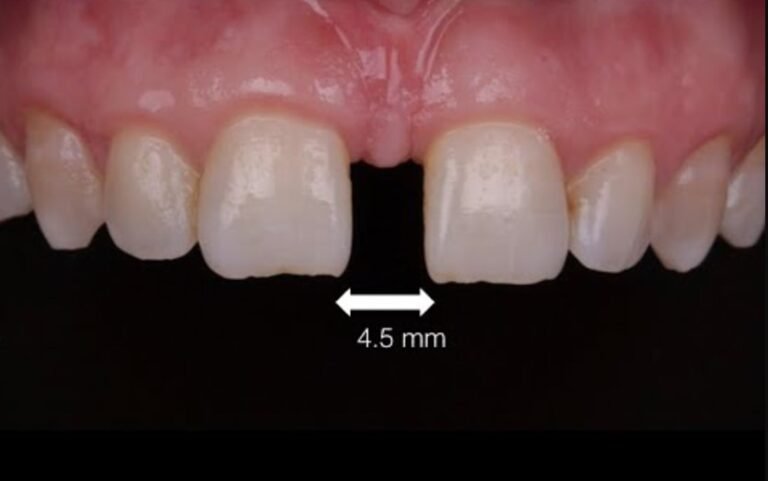 Closing Diastema with Proximal Unica Matrix: A Seamless Approach for Dental Clinics