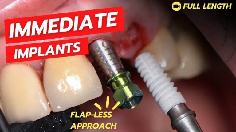 Understanding Extraction and Immediate Placement (Flapless) in Dental Procedures